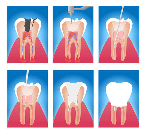 歯を残すための根管治療