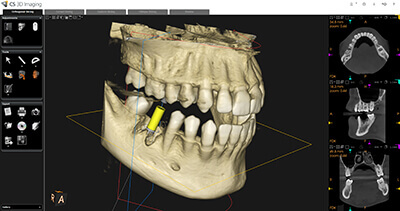 歯科用CTによる精密な診査診断