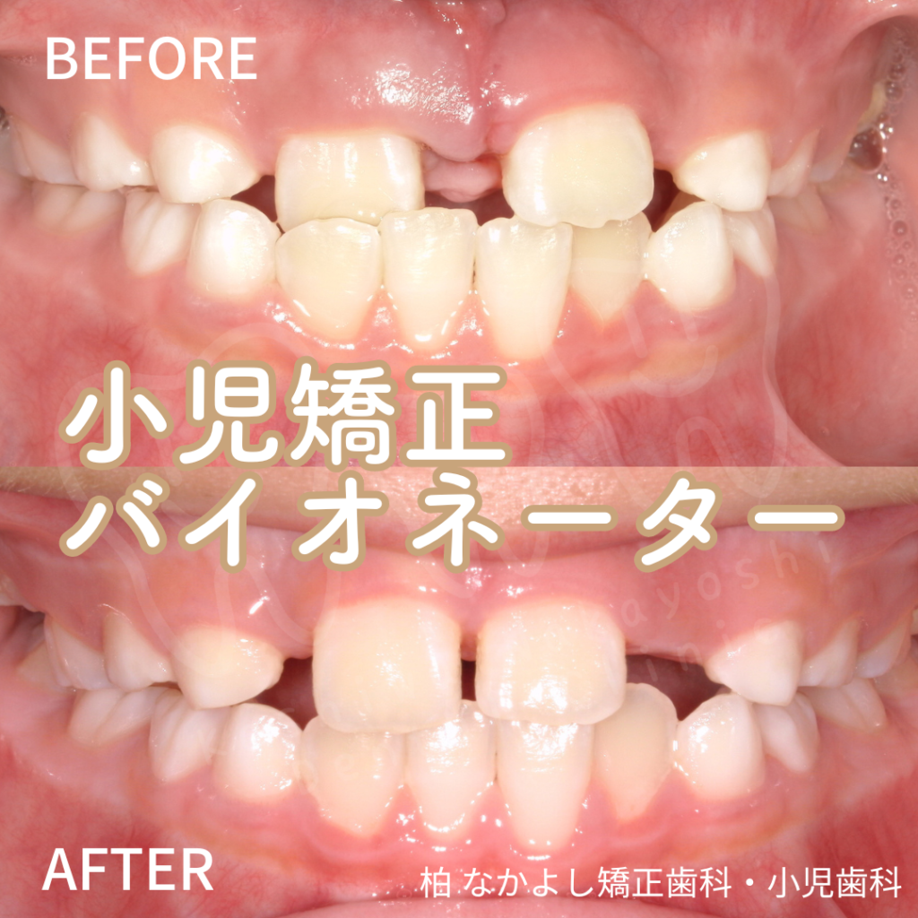 小児矯正(バイオネーター)　症例写真
