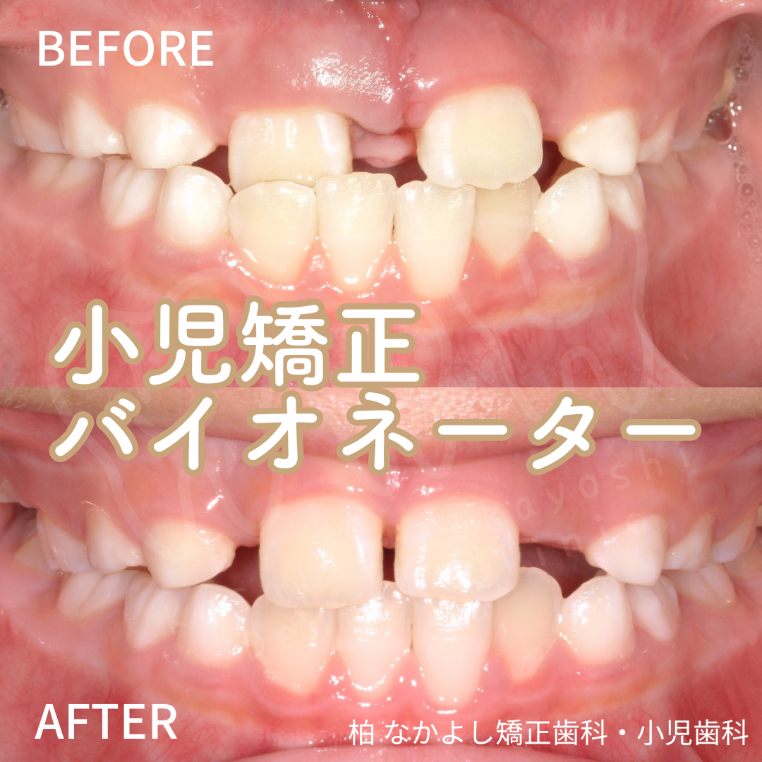 小児矯正(バイオネーター)　症例写真
