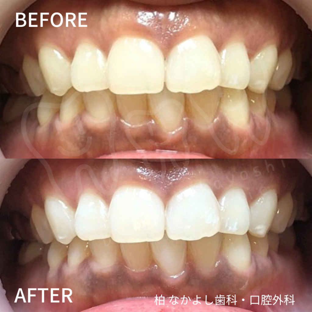 ホワイトニング　症例写真